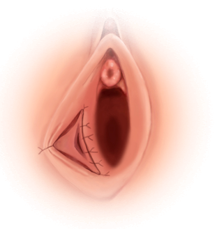 바톨린 낭종 치료 — 절개로 배출 통로를 만드는 시술 모식도