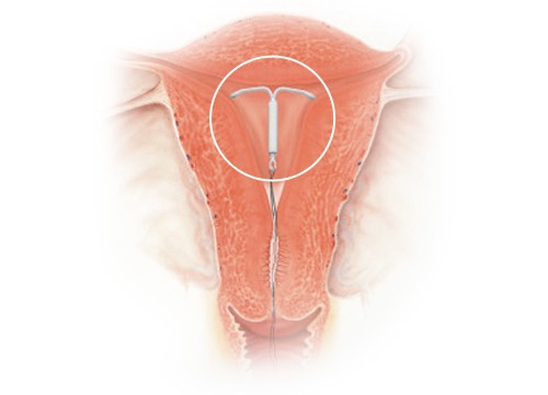 자궁내 장치(루프, IUD) — 자궁 내 T자 장치 삽입 위치